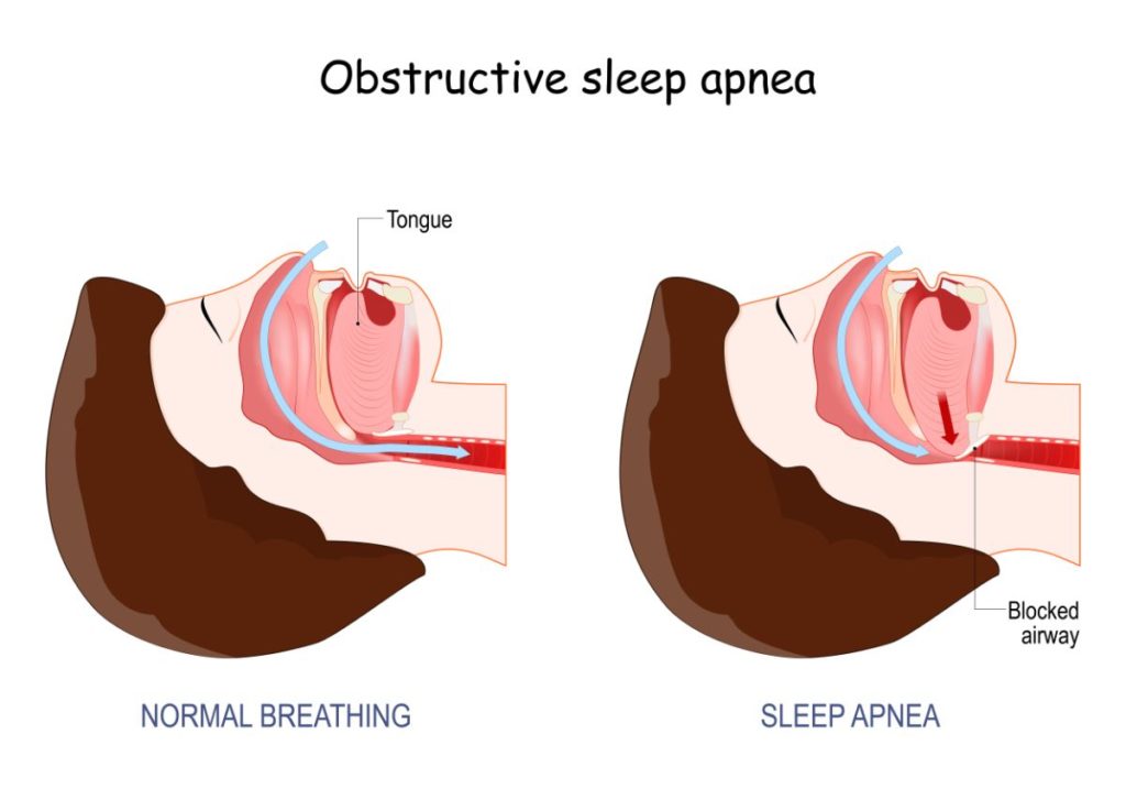 Can Orthodontics Help Sleep Apnea and TMJ?