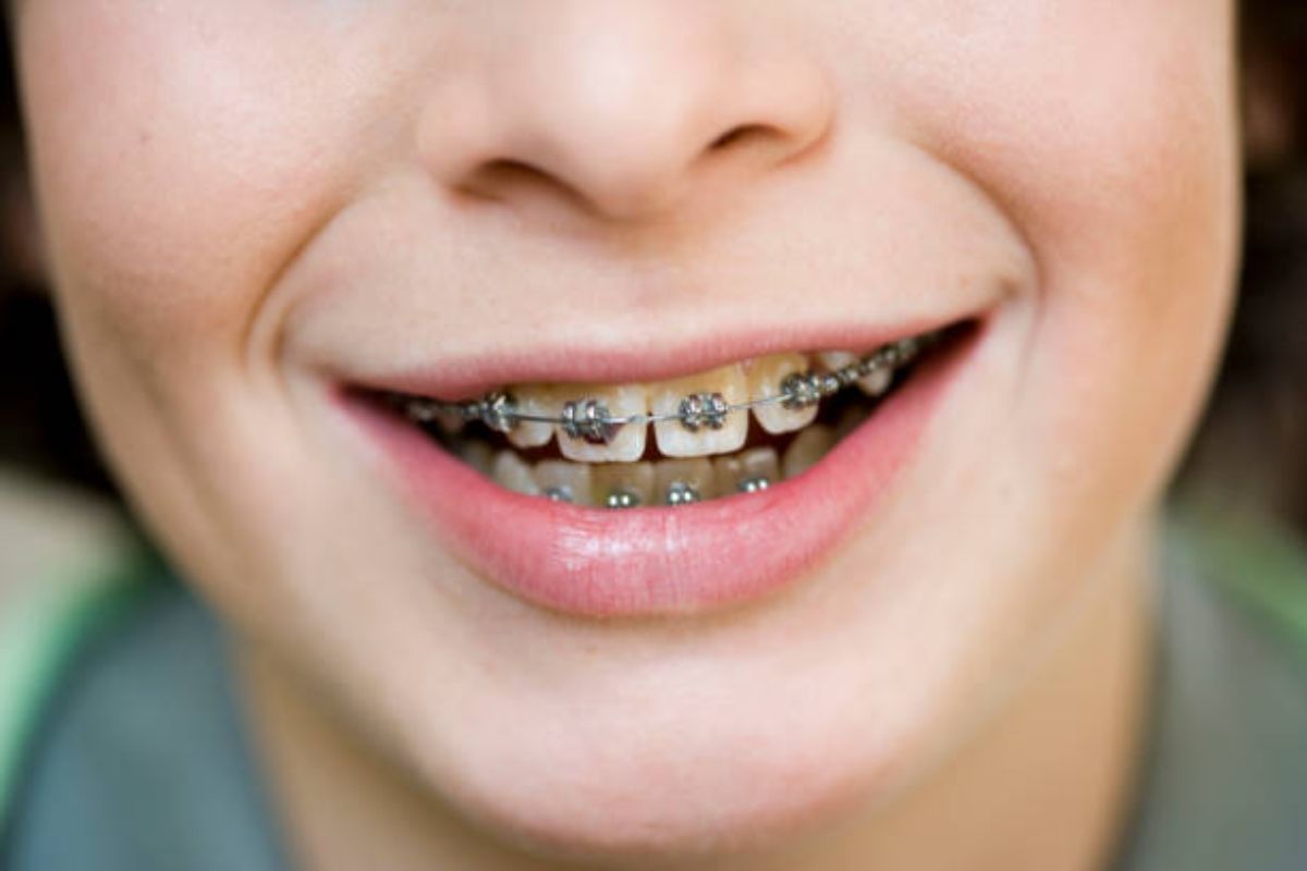 10 Braces Myths You Need To Know
