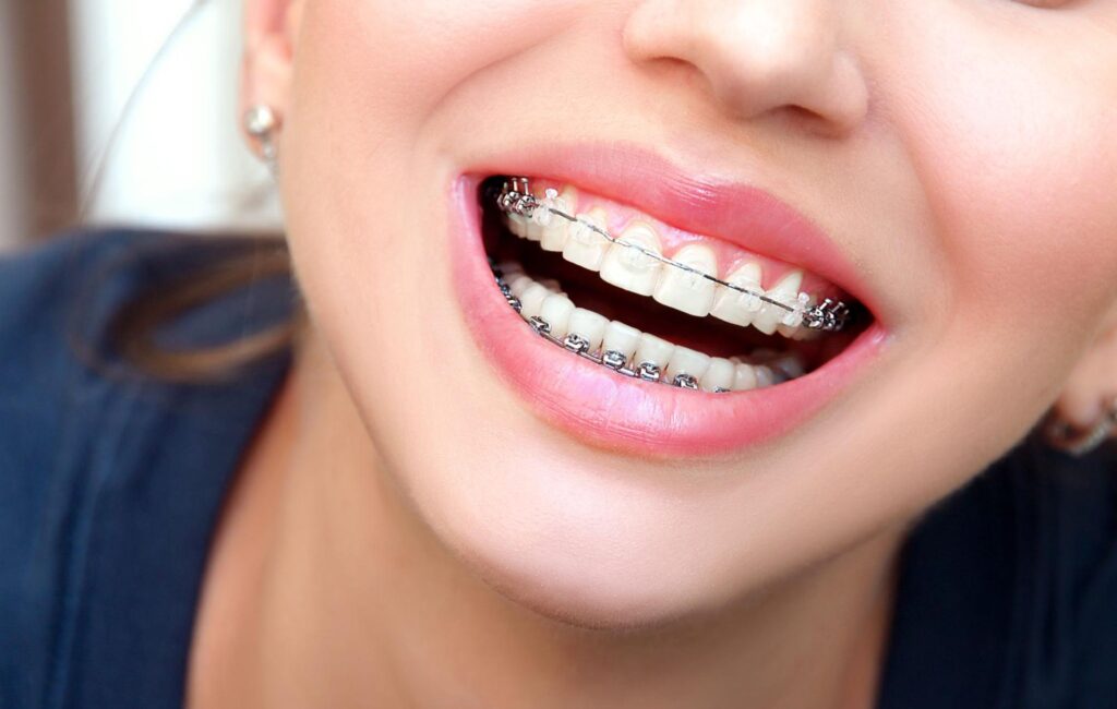 What Are Some Benefits of Orthodontic Treatment for Adults?