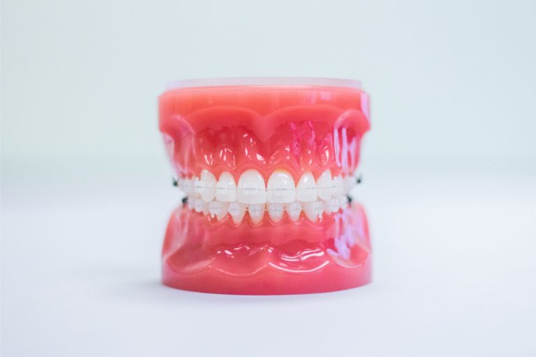metal braces prattville al