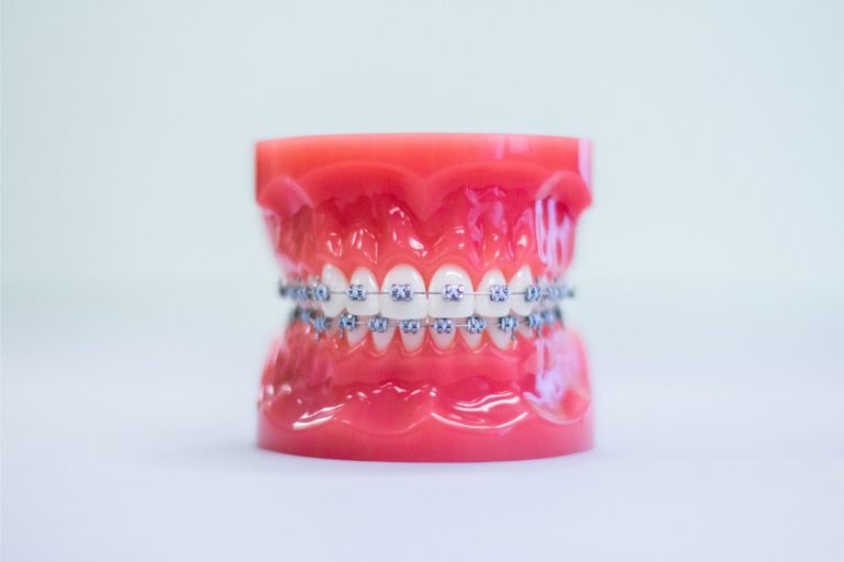 metal braces prattville al