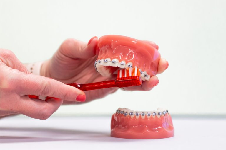 metal braces prattville al