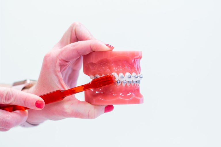 metal braces prattville al